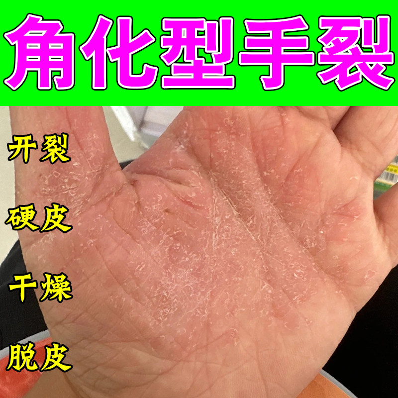 冶手干燥粗糙裂起皮干裂角质化增厚开真菌变硬起皮植物萃取修护膏