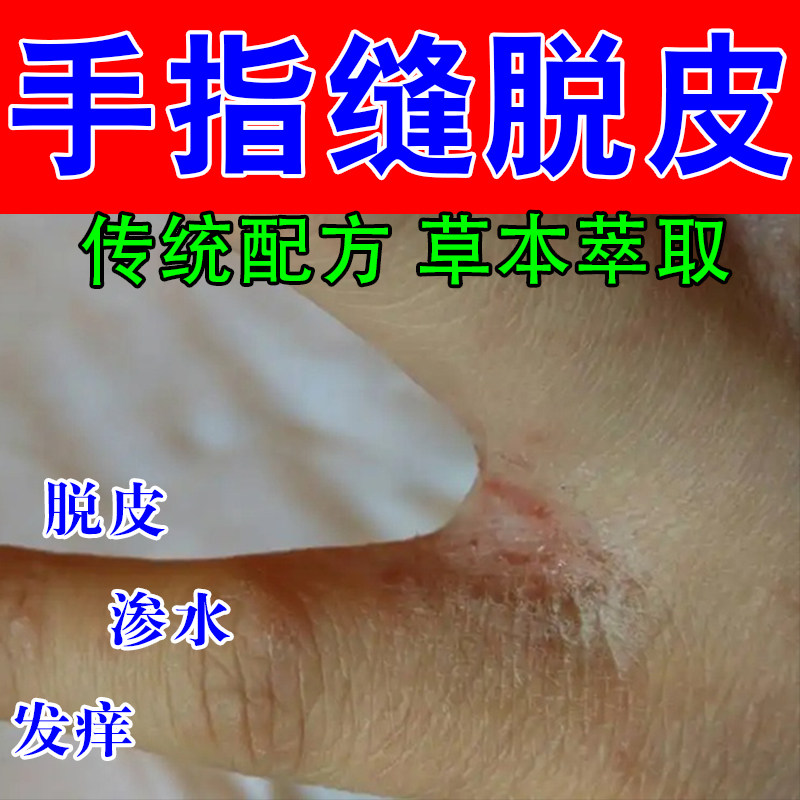 手指缝脱皮软膏起皮手丫指缝中间痒开裂发红脱皮分离水泡专用膏