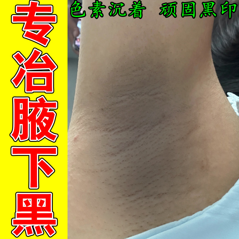 腋下褶皱发黑腋窝肌肤粗糙胳肢窝肤色发暗腋下角质厚重按摩膏