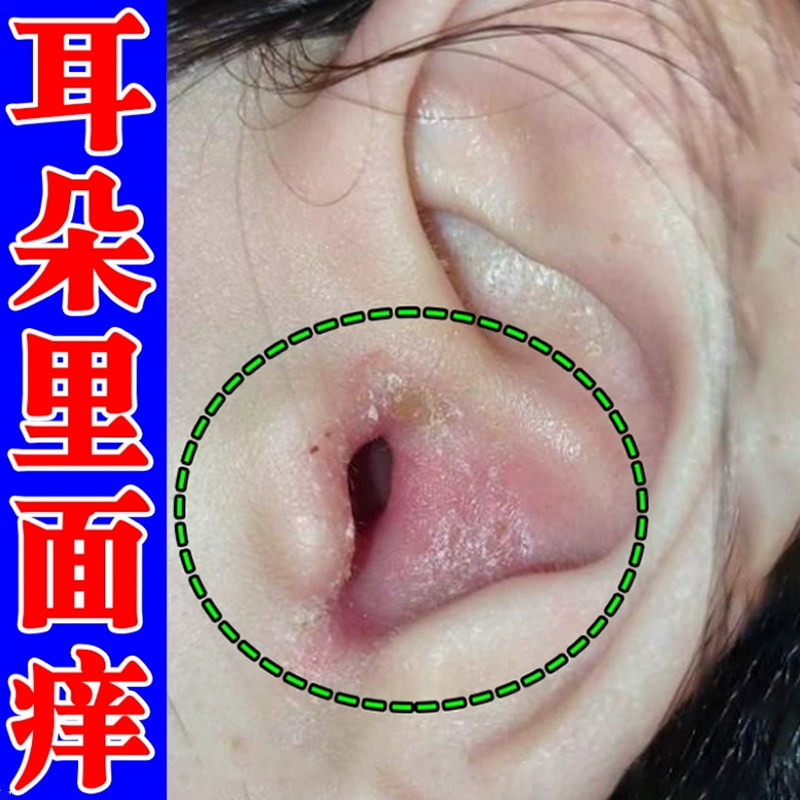 冶耳朵里面痒的软膏起干皮真菌感染红肿起皮外耳道起皮脱皮干燥痒