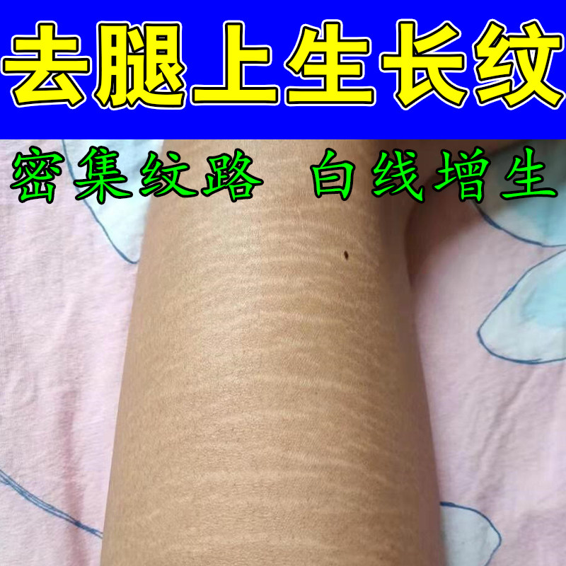 肥胖纹生长纹红色白淡化大腿学生腿上部淡化纹路肥胖纹植物修复膏