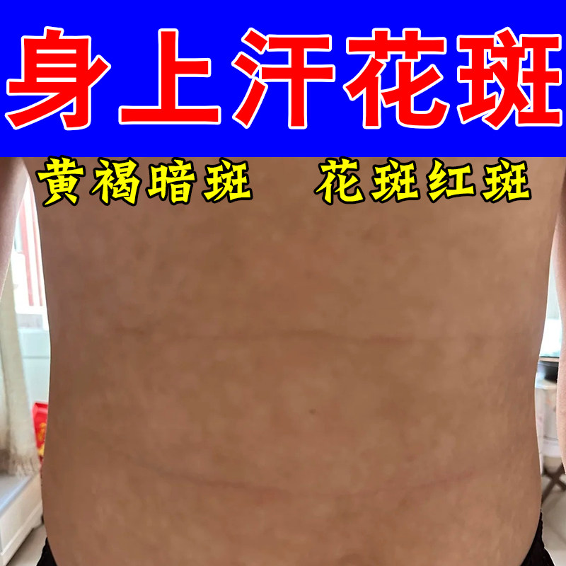汗斑净花斑用冶汉斑花斑皮肤痒去腋下白斑片状深色斑点汗斑膏乳