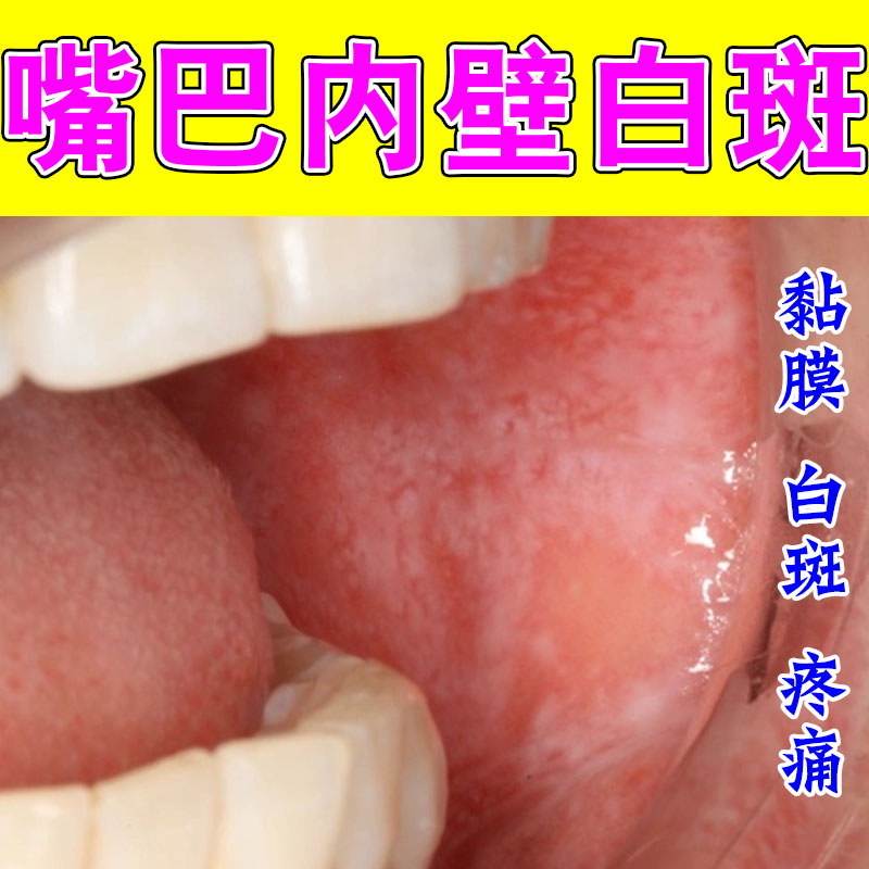 口腔内壁黏膜纤维化白斑修护口腔内部难受草本口腔养护喷剂