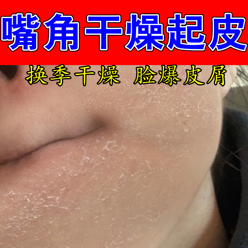 嘴周围干燥粗糙发痒起屑脸部干燥起皮泛红脱皮下巴周脱皮保湿甘油