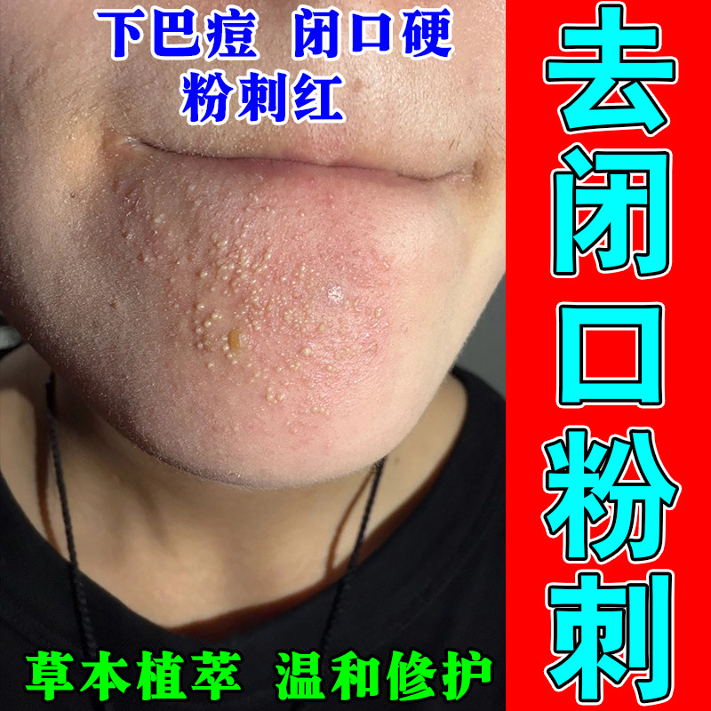 下巴闭口粉刺上火红肿硬块起包下巴反复长颗粒疙瘩冒白尖修护膏