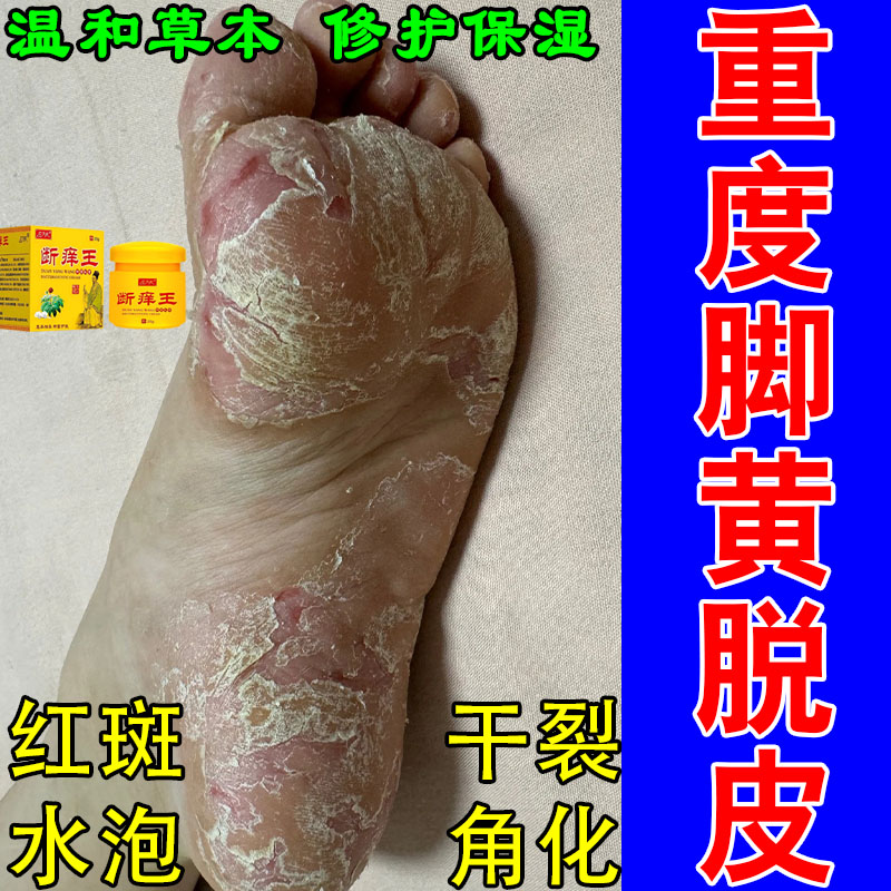 足掌跖手脚干燥粗糙起皮脱皮干裂角质增厚泛红肌肤舒缓呵护软膏