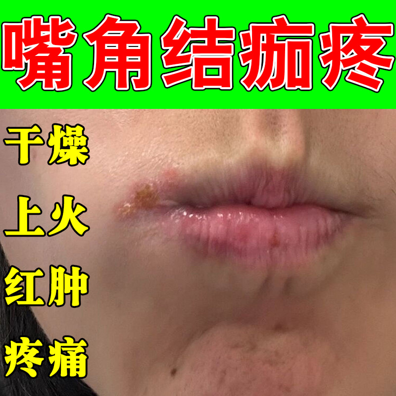 嘴角上火疼皮唇嘴唇周围一圈红斑干裂脱皮嘴巴过敏起皮上火保湿膏