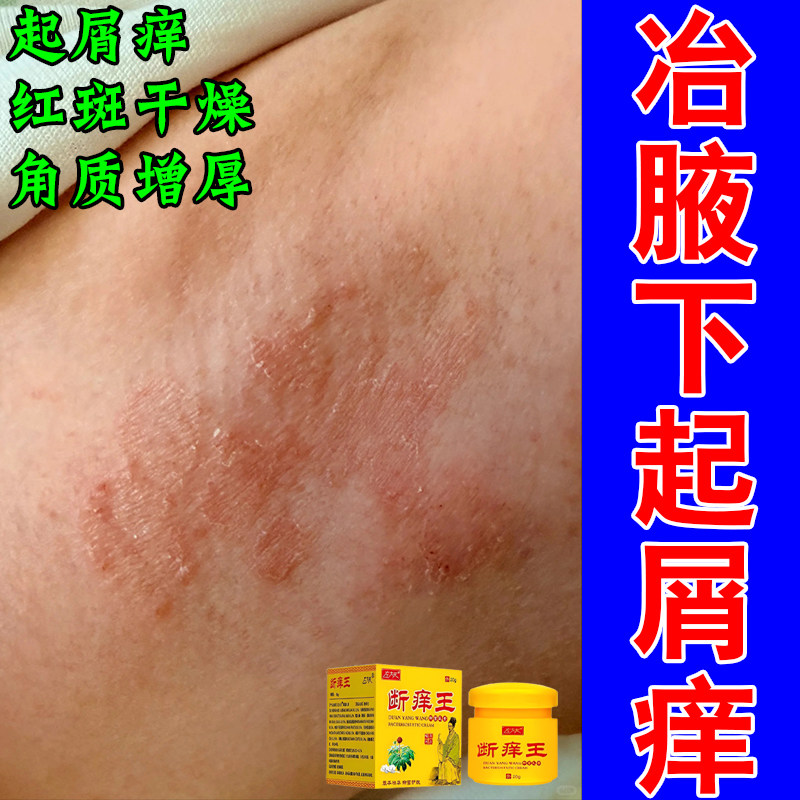 冶腋下粗糙起屑痒红腋窝红肿干燥粗糙起屑痒修复草本舒缓膏乳