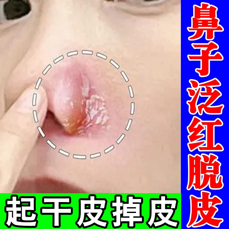鼻子两侧泛红脱皮鼻子两侧痘痘发红起干皮干燥痒鼻翼两侧发红起皮