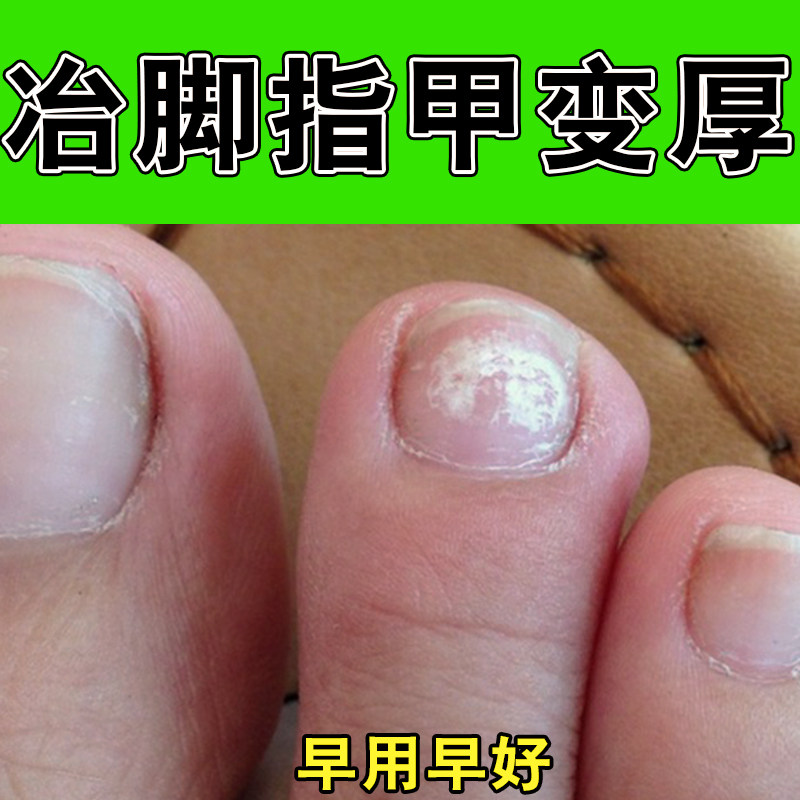指甲发黄增厚变硬软化膏脚趾甲盖变空甲板甲床分离凹凸不平修护膏