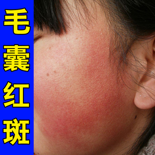 脸上毛囊红斑黑变病毛周角化脸颊两边小疙瘩