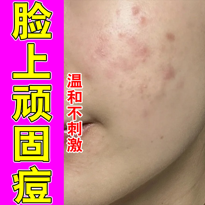 脸颊两侧红肿硬痘干燥起皮保湿成人粉刺疙瘩修护草本萃取霜