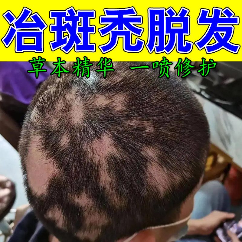 斑秃头顶稀少毛囊减少头顶大把掉发后脑勺光秃修护育草本护发喷雾
