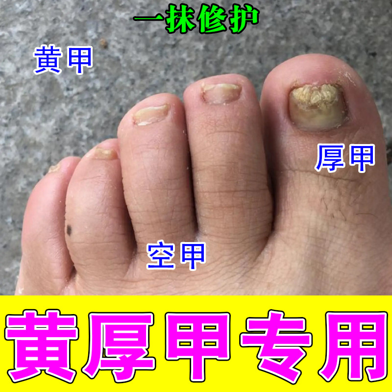 脚指甲发黄变厚变硬增厚白甲空甲修复甲分离脱落软化修复指甲液
