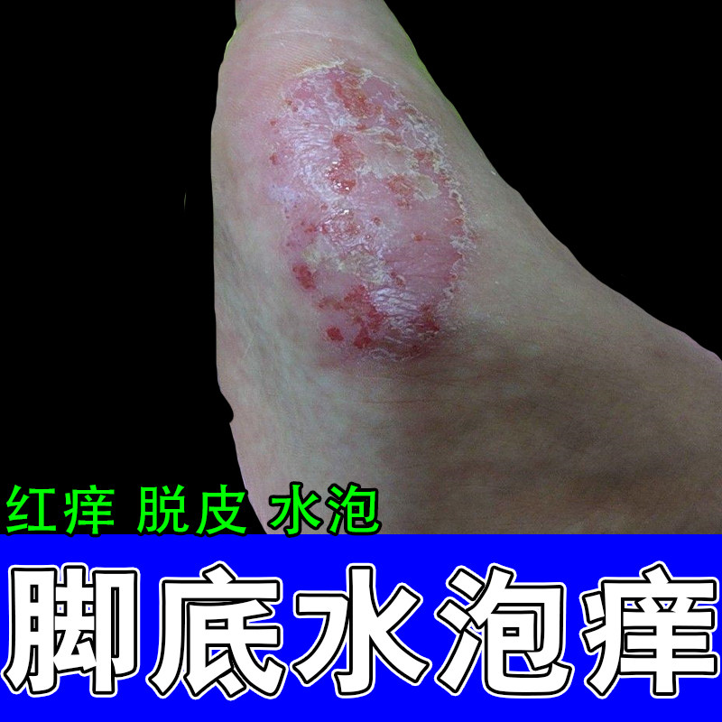 脚长水泡起皮脱皮疙瘩发痒起皮脚掌粗糙痒反复脚痒草本修护乳膏