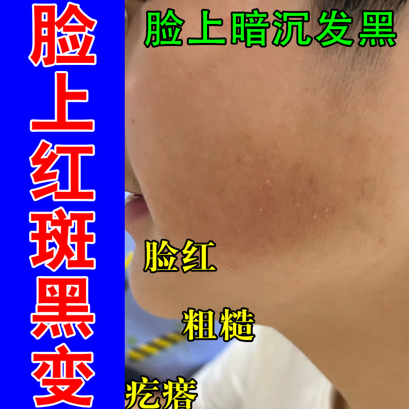 脸上毛囊红斑黑变毛周角化面颊颗粒凸角质堆积暗沉发黑泛红修护膏