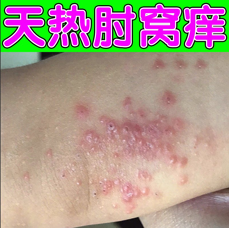 手肘窝胳膊肘内侧疙瘩红点特应性天热起小红豆膏