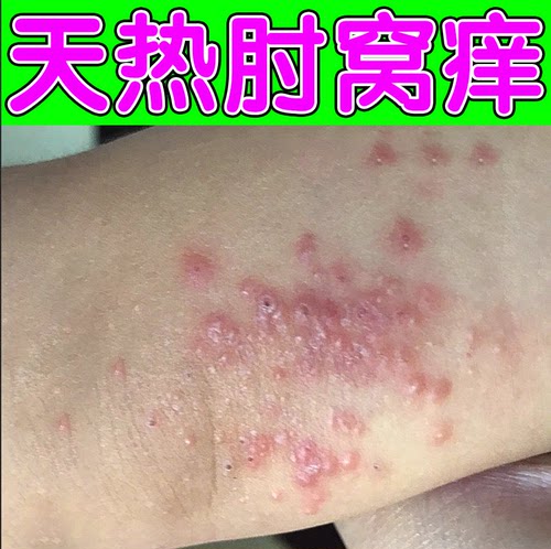 手肘窝胳膊肘内侧疙瘩红点特应性天热起小红豆膏