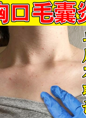 前胸后背长豆豆毛囊炎真菌感染身上红色丘疹除螨虫脂溢性专用软膏