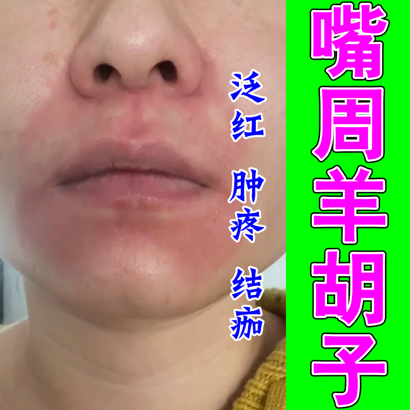 小孩频繁舔嘴羊胡子口周干红发疼干裂泛红肿起植萃润肤保湿膏