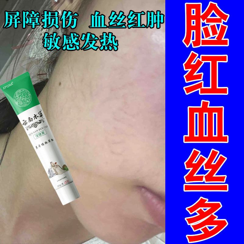 脸上长红血丝泛红干燥起皮修复脸部红痒起皮泛红专用乳膏