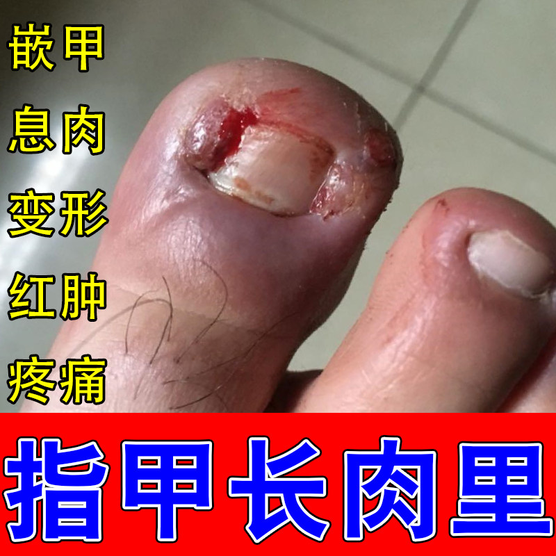 甲沟红肿疼息肉手脚指甲旁扎肉红肿发发红肿大化脓痛扎肉膏乳修护