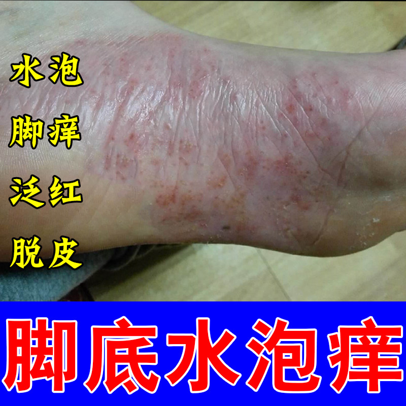 脚长水泡起皮脱皮疙瘩发痒起皮脚掌粗糙痒反复脚痒草本修护乳膏