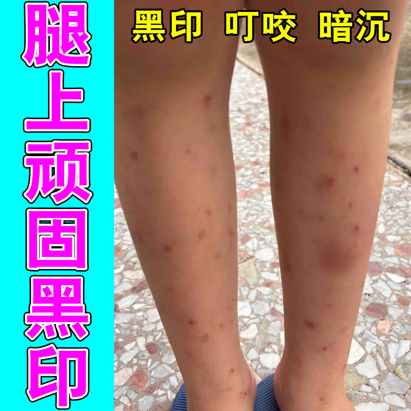 蚊虫抓挠皮肤暗沉黑斑明显深色黑印全身适用积雪草按摩膏