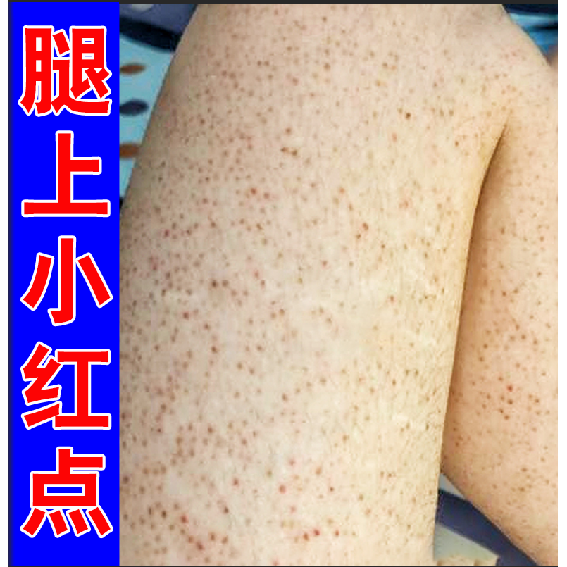 毛囊角化软膏身上腿部胳膊上小疙瘩黑点鱼鳞蛇皮身体乳