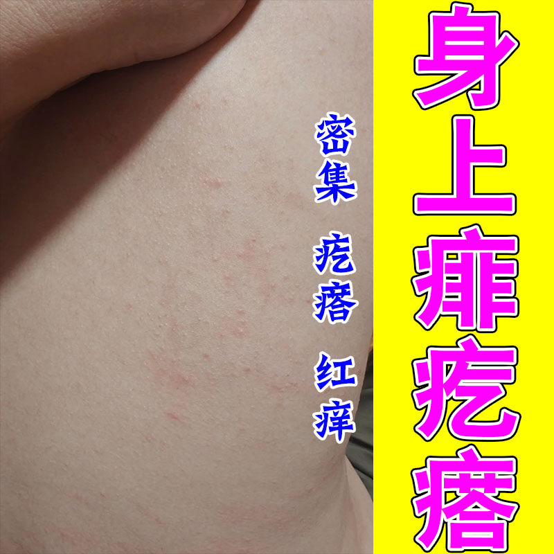 成人专用痱子痒夏季天热大人热痱红疙瘩密集草本修护喷剂