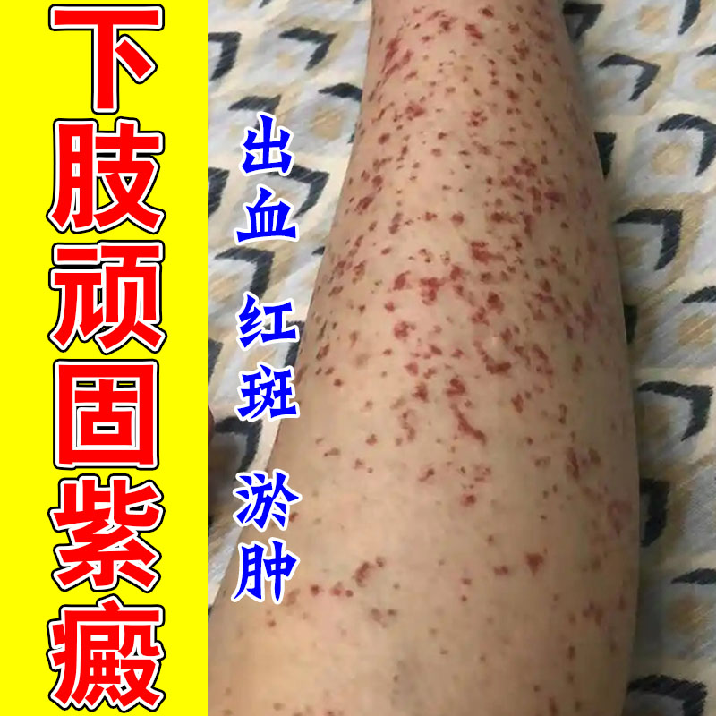 紫癜皮下小红点紫点改善肌肤淤斑暗沉色素修护膏