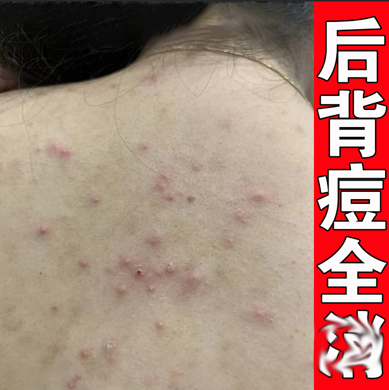 去除背上长痘痘软膏淡化后背脖子后面痘印祛痘背后身体螨虫药神器