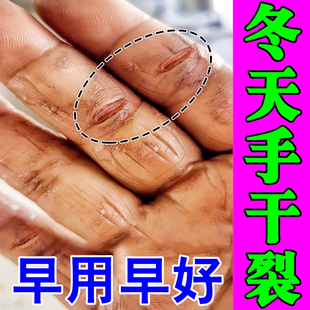 手指裂口子干燥粗糙爆干皮冶手指缝裂膏手指头干裂皲裂脱皮修复霜