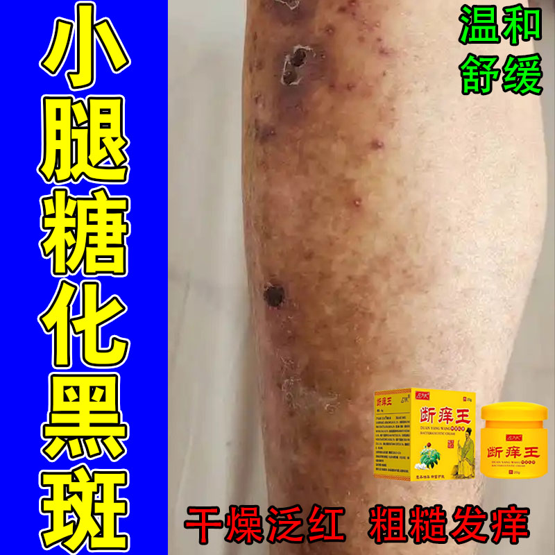 老年人高糖肌肤色素暗沉全身干燥脱皮痒糖斑粗糙干燥发痒修护膏
