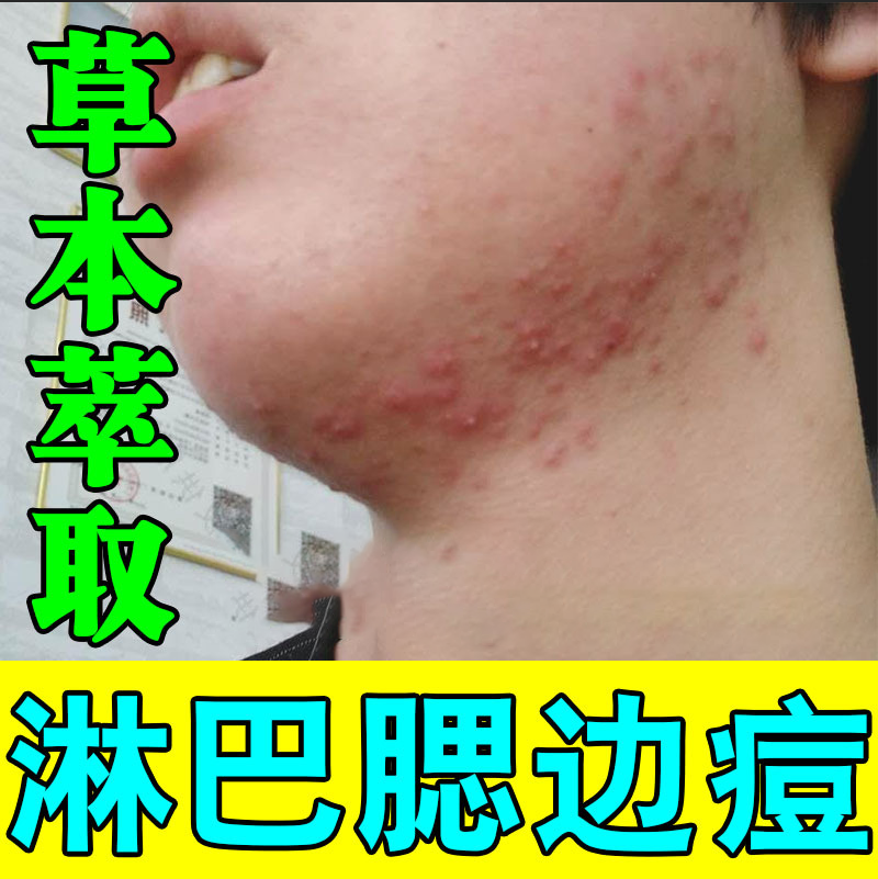 腮边痘痘淋巴痘反复脸上长痘痘红肿结节硬块修复消炎淡化痘印痘坑