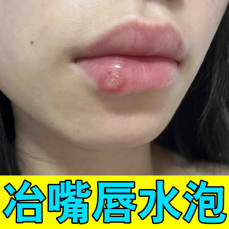 嘴唇起泡嘴巴周围上火干裂干燥烂嘴角开裂口角炎干燥起皮唇润唇膏