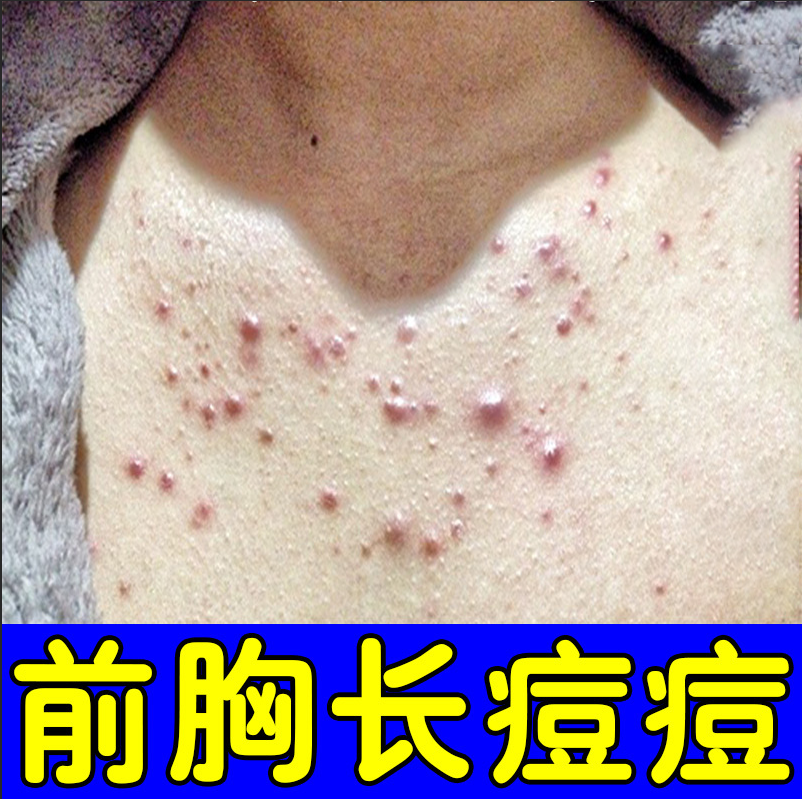 胸前痘痘胸口发红发痒长小红点疙瘩背上脓包前胸后背祛痘专用软膏
