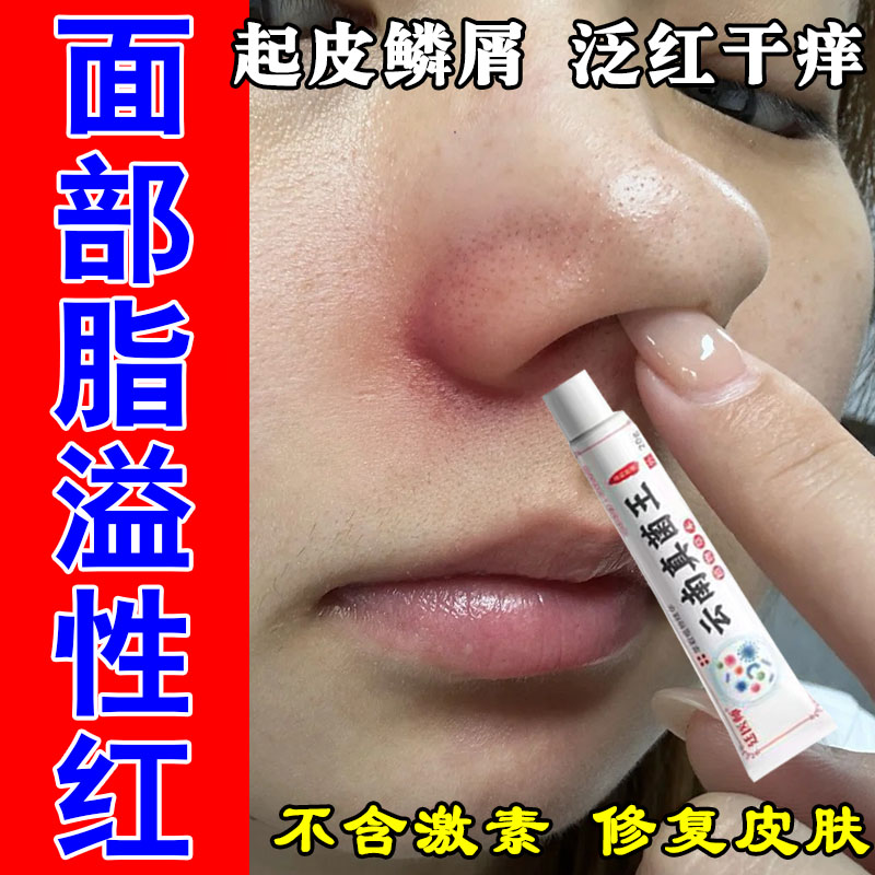 冶脂溢性鼻侧发红起皮脸上鼻翼两边泛红痒干燥起皮草本修护乳膏