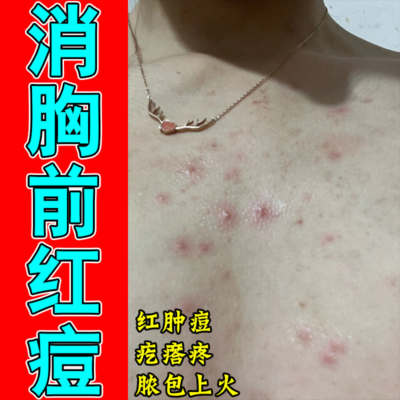 胸前痘前胸长痘胸上毛囊前胸后背痘疙瘩红肿疼修护植物膏