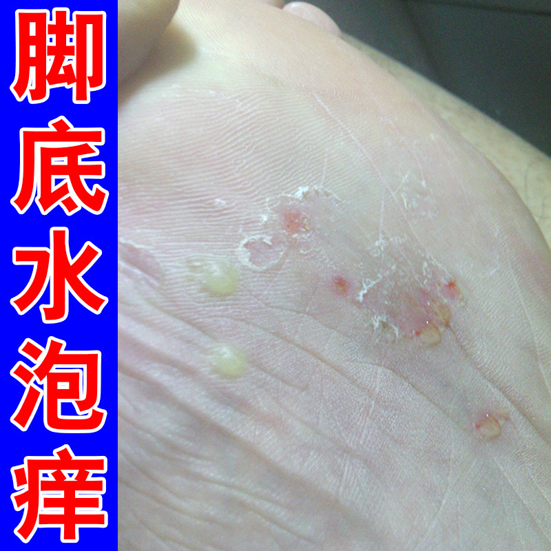 脚底起小水泡脚痒脚掌心足底痒专用膏