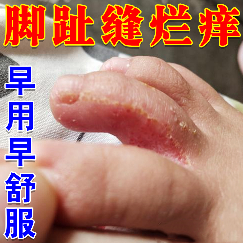 脚趾头缝烂痒脚趾头缝脱皮痒脚掉皮发痒烂脚丫脚趾间糜烂溃烂