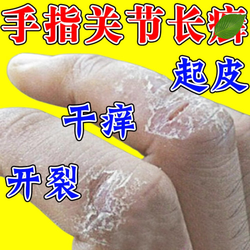 去除手指关节专用手指关节长硬疙瘩脱皮开裂开裂
