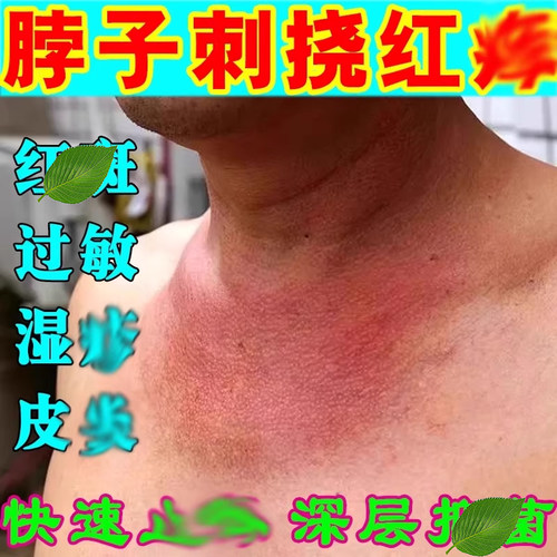 脖子专用颈部后面出汗刺挠正品