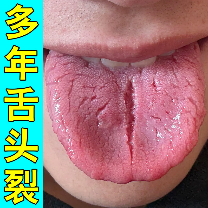 舌头长期裂纹齿痕舌苔白厚灼痛起泡口苦正品喷剂