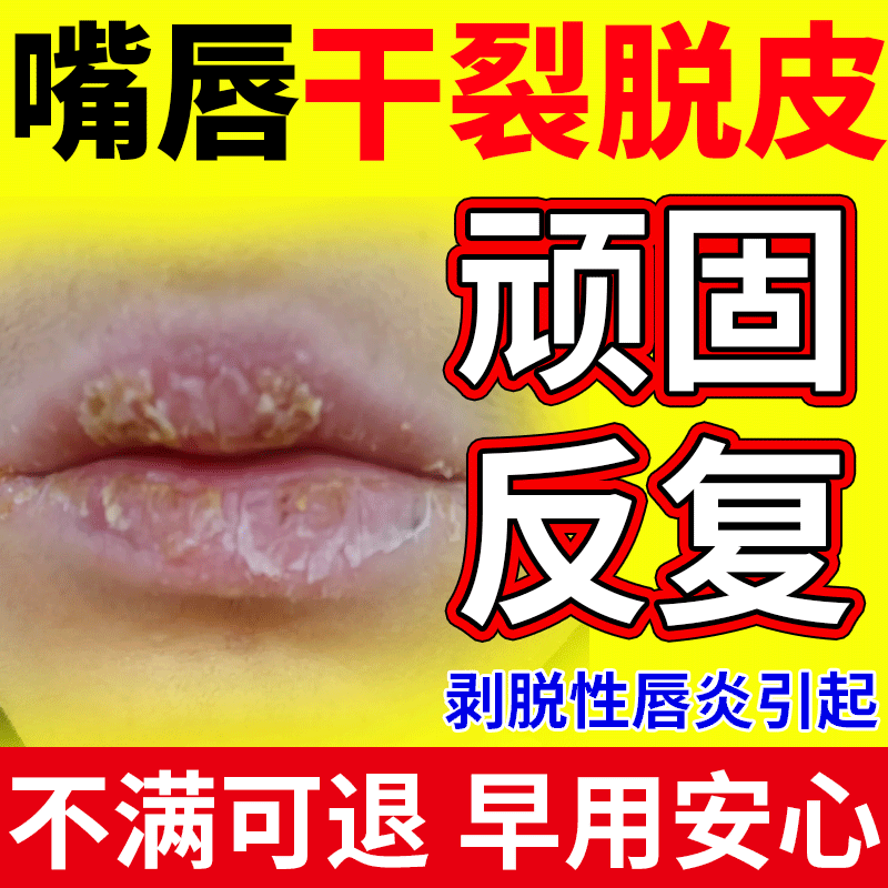 【嘴唇干裂脱皮反复】现货速发