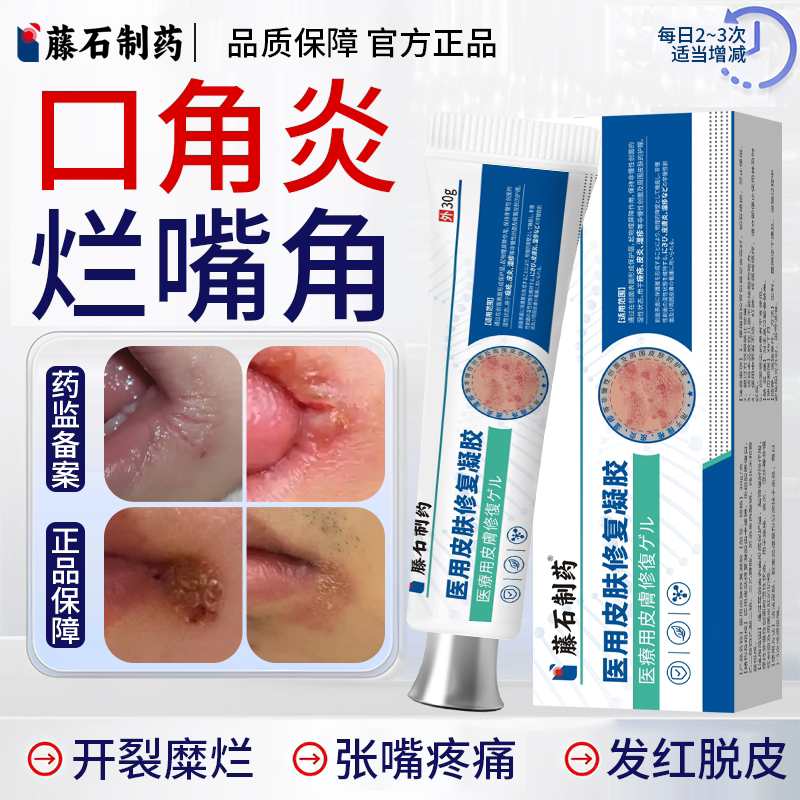 嘴角烂口角炎藤石制药膏专嘴角裂口用疱疹开裂儿童嘴唇上火起泡OZ
