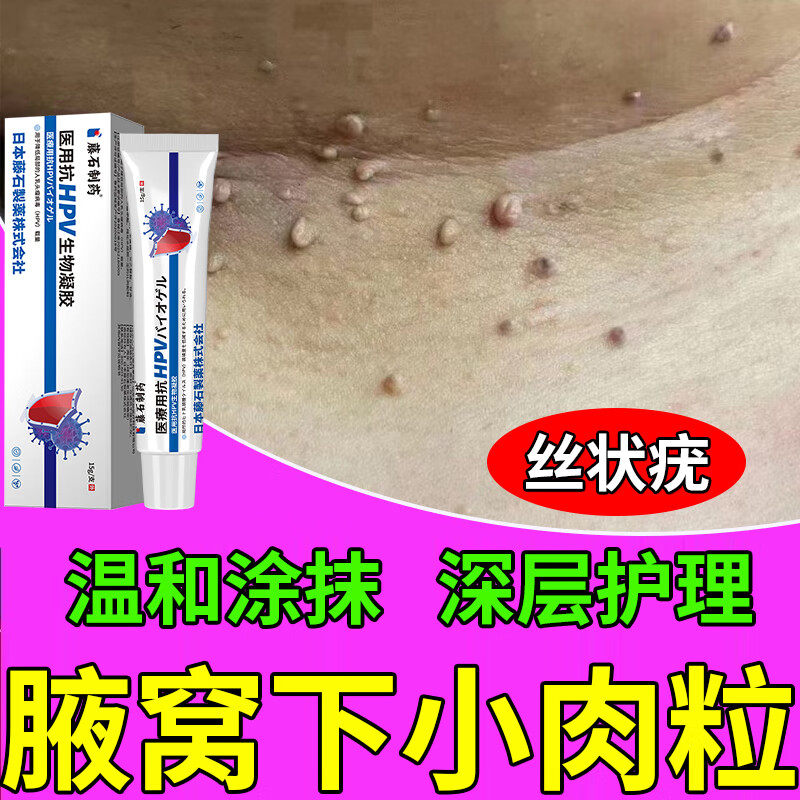 腋下小肉粒疙瘩脖子上长的丝状疣庞去除神器去疣瘊皮赘药房款膏DZ
