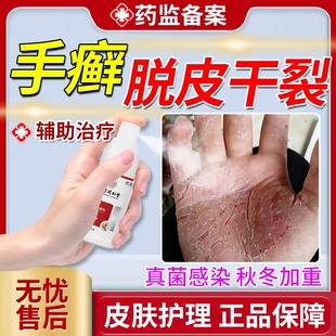 手癣膏脱皮干裂真菌感染鹅掌风专用药房款膏湿疹止痒去手足癣根OZ
