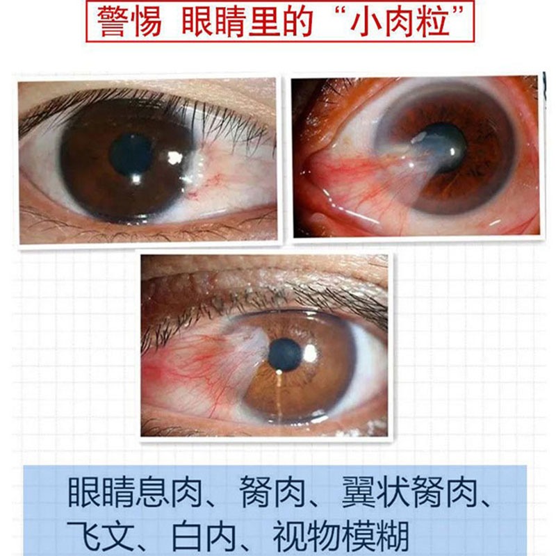 去除眼睛胬肉滴眼-液眼睛长胬肉模糊看不清有异物感翼状胬肉眼