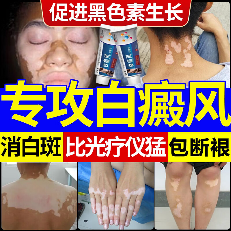 仲景堂白癜风外用药膏快速消白斑治疗白斑色素脱失促进黑色素生长
